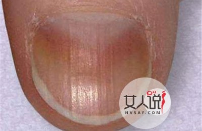指甲上有白点 身体发出的信号注意接收